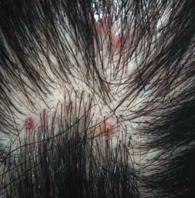    folliculitis bntpal.com_145846420