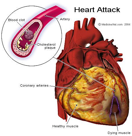  Heart Attack bntpal_1438590417_60