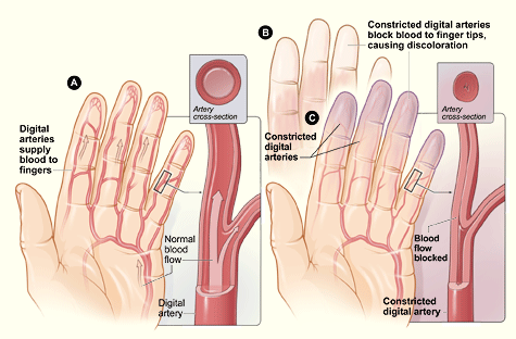  Raynaud Disease bntpal_1438590476_44