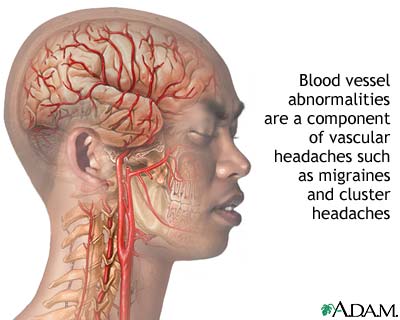 Migraine Headaches bntpal_1438757923_77
