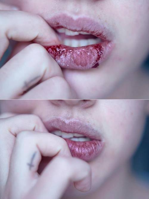 bloody lips bntpal_1453291677_84